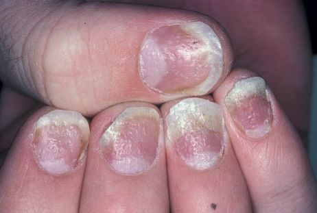 新型抗炎药！优时比首次公布数据显示：Cimzia可有效清除银屑病患者的指(趾)甲疾病