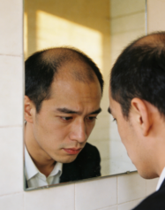 持续性脱发别硬扛！错过黄金期多花冤枉钱，大麦脱发医院国贸门诊部教你正确